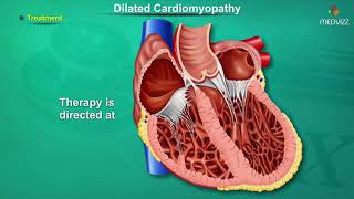 Dilated cardiomyopathy  DCM   Causes Signs and Symptoms Pathogenesis Diagnosis and Treatment [upl. by Ike]