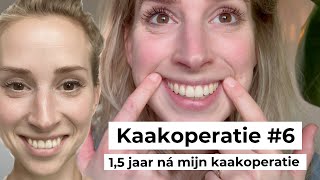 KAAKOPERATIE  ALLES WAT JE WILT WETEN  15 jaar na mijn operatie [upl. by Jacqueline972]