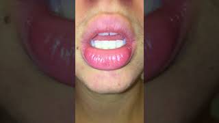 exfoliative cheilitis  day 0 pre treatment  tacrolimus amp burts bees wax hand salve [upl. by Euqinu]