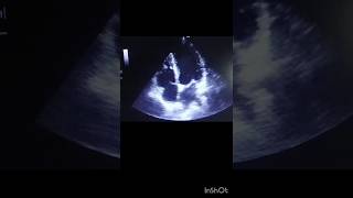 echocardiography echocardiographer echo video echo case rheumatic heart disease [upl. by Dunning757]