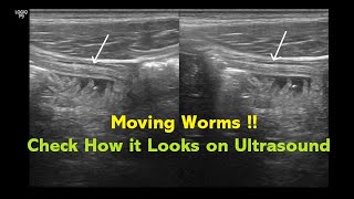 Intestinal Helminthiasis Ascariasis  Ultrasound  Case 04 [upl. by Tarsuss268]