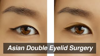 Asian Blepharoplasty Monolid to Double Eyelid Surgery [upl. by Oilla]