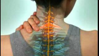 Cervical Radiculopathy  DePuy Videos [upl. by Duff]