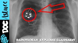 🔴 5 Dr Astuce  APPRENDS LE SYNDROME ALVEOLAIRE EN  DE 5 MIN  partie 1  Dr Astuce [upl. by Tabshey]