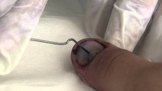 Trephining a nail to drain subungual haematoma [upl. by Liagaba]