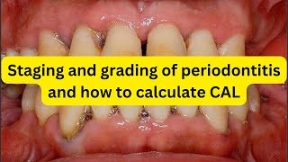 Staging and grading of periodontitis and how to measure CAL and RBL [upl. by Eednim]