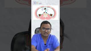 Understanding Ovarian Cancer How it Spreads and Causes Abdominal Swelling  Dr Praveen Kammar SSO [upl. by Ainegul]