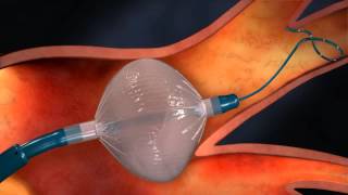 AFIB ablation using Cryoballoon Technology [upl. by Nitaf]