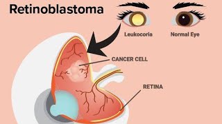 Hereditary Retinoblastoma as a result of RB1 Gene mutation Causes Symptoms and Treatment [upl. by Dnomal]