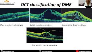 Diabetic macular edema Pathophysiology Diagnosis and management [upl. by Esylla269]