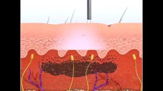 RevLite and MedLite Lasers Remove Dermal Pigment [upl. by Yenobe]