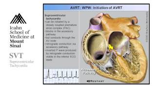 Supra Ventricular Tachycardia [upl. by Anzovin]