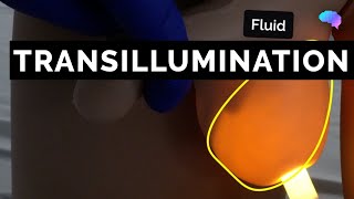 Transillumination  Scrotal Examination  OSCE Guide  UKMLA  CPSA [upl. by Otreblanauj]