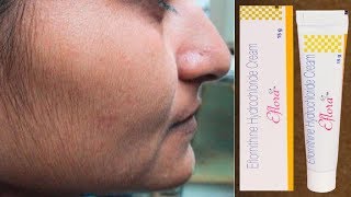 Eflora Cream for Facial Hair Removal  Eflora cream uses in Hindi [upl. by Itnahs]