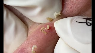 Acne Treatment Huong Da Nang  590 [upl. by Adena]