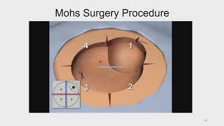 Mohs Micrographic Technique  An Overview [upl. by Neilla8]