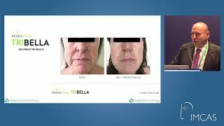 IMCAS Presentation with Dr Neil Sadick on TriBella™ [upl. by Merline]