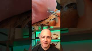 Doctor reacts to fat splinter removal dermreacts doctorreacts splinter splinterremoval [upl. by Jezabel]