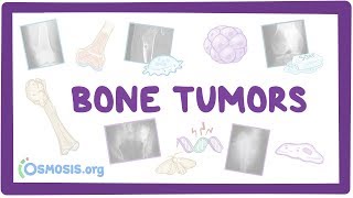 Bone tumors  causes symptoms diagnosis treatment pathology [upl. by Neiluj]