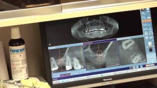 EXPLICIT  Internal Sinus lift  Osteotome technique  Dental Surgery [upl. by Adelle815]