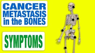 Cancer Metastasis in the Bones  All Symptoms [upl. by Casi]