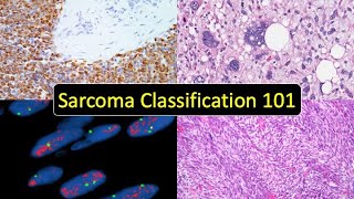 Sarcoma Classification 101 Soft Tissue Tumor Naming Made Simple for Beginners amp NonPathologists [upl. by Notneb]