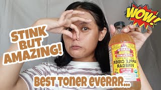 5 DAYS APPLE CIDER VINEGAR TONER ON ACNE PRONE SKIN REVIEW  English [upl. by Maritsa]