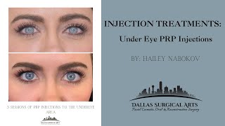 PRP Injections to UnderEye with Hailey Nabokov at Dallas Surgical Arts [upl. by Braunstein]