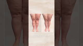 Lipedema Liposuction Before amp After Results  Salameh Plastic Surgery [upl. by Schaumberger]