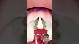 Hip Osteotomy for Dental Implants – Register Now to Learn More funny shorts viralvideo [upl. by Sitoiganap]