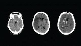 How to Read a CT Scan of the Head  MEDZCOOL [upl. by Loggins]