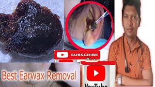 best earwax remover [upl. by Nilyak]