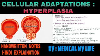 Cellular Adaptations  1  Hyperplasia  Pathology [upl. by Dickinson]