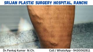 Laser treatment of varicose veins Best treatment of varicose veins varicose veins treatment [upl. by Niryt]