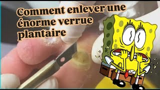 Comment enlever une énorme verrue plantaire [upl. by Yenatirb]