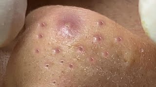 Big Cystic Acne Blackheads Extraction Blackheads amp Milia Whiteheads Removal Pimple Popping  8251 [upl. by Fidellia]