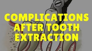 Complications After Tooth Extraction Symptoms amp Treatment Fast Relief [upl. by Marybeth]