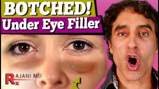 BOTCHED UNDER EYE FILLER  Under Eye Filler [upl. by Ahgem]