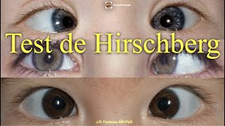 Test de Hirschberg [upl. by Ashling]