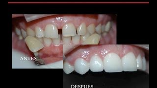 Carillas dentales  Sonrisa Hollywood  explicacion facil de entender  video para pacientes [upl. by Teeniv969]