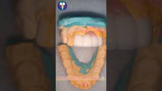 Ceramic Teeth  Upper Anterior  Maxillary Insicor  PFM  Tamil Dental Lab  tamildentist shorts🦷 [upl. by Oderf947]