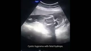 cystic hygroma with fetal hydrops [upl. by Meirrak]