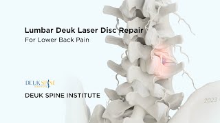 Lumbar Deuk Laser Disc Repair DLDR for Discogenic Back Pain  3D Animation [upl. by Anair]