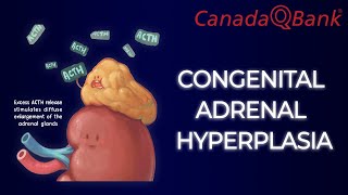 Congenital Adrenal Hyperplasia [upl. by Soilissav600]