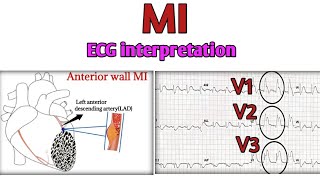 Myocardial infraction on ECG leadsAnterior wall MIinferior wall MIlateral wall MIPosterior MI [upl. by Inajar]