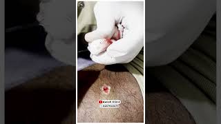 Get Rid of Warts Quickly and Easily Easy and PainlessAWISH Clinic [upl. by Eet328]