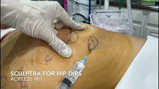 Sculptra filler treatment for hip dips  Ageless MD [upl. by Husein974]