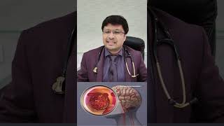 लकवे के मरिजो Stroke patients THROMBOLYSIS and its role [upl. by Joshi]