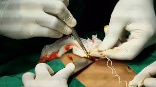 Open Appendectomy  Live surgical video [upl. by Vivica]