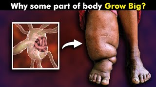 Elephantiasis Causes Symptoms and Treatments of Elephantiasis [upl. by Patty]